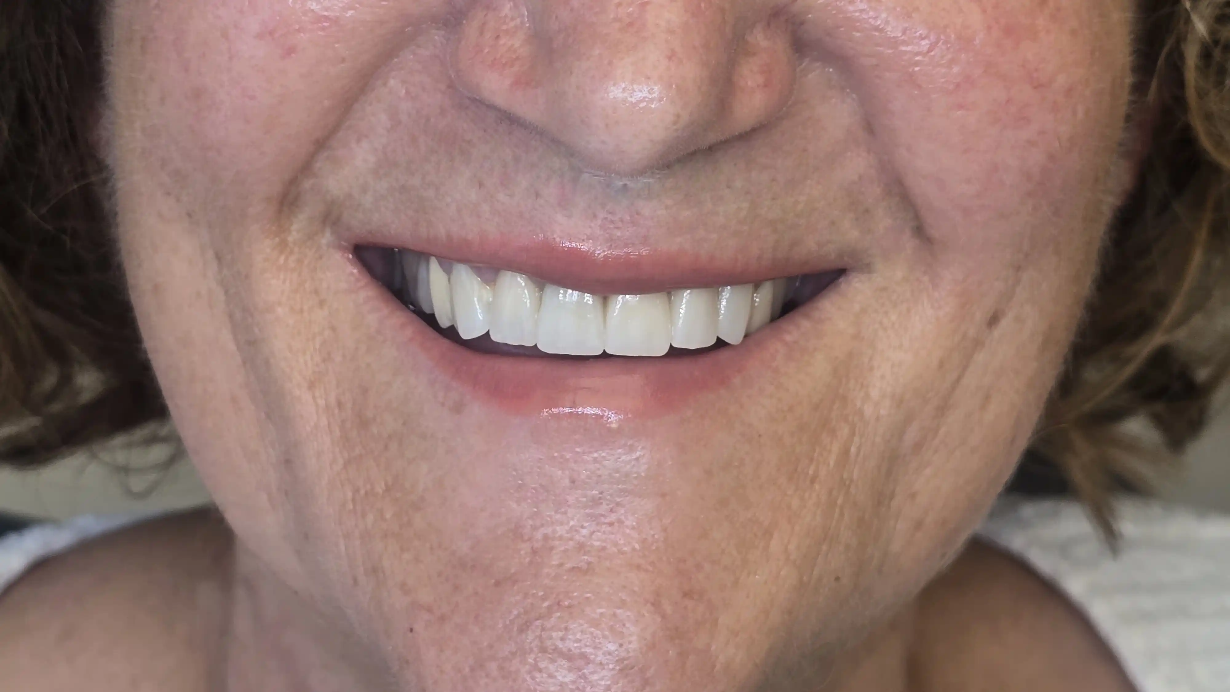 After: Zirconia crowns